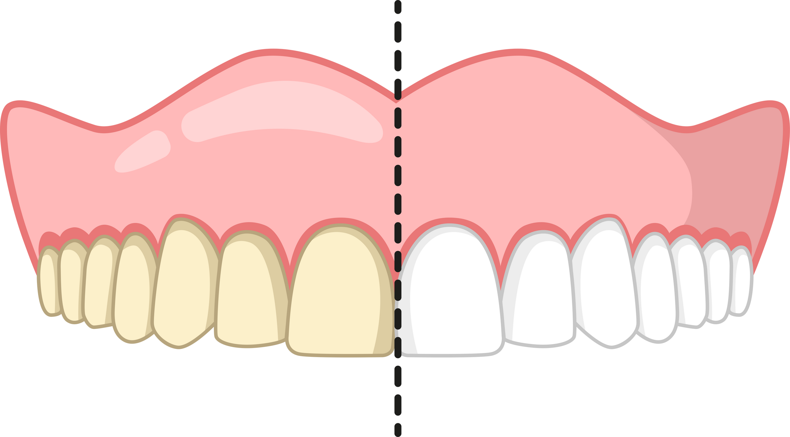 teeth whitening